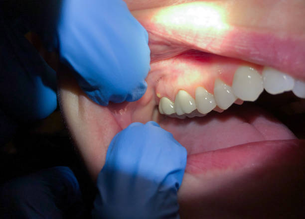Best Emergency Dentist for Knocked-Out Tooth in Moncks Corner, SC