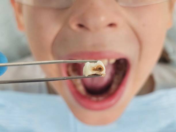 Best Emergency Root Canal Treatment in Moncks Corner, SC